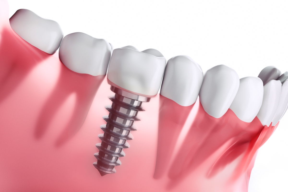 dental implants in Millbrae