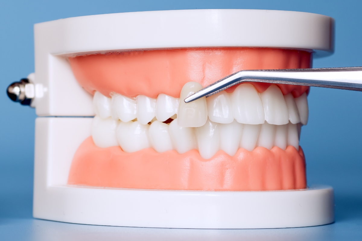 porcelain-veneers-in-Millbrae