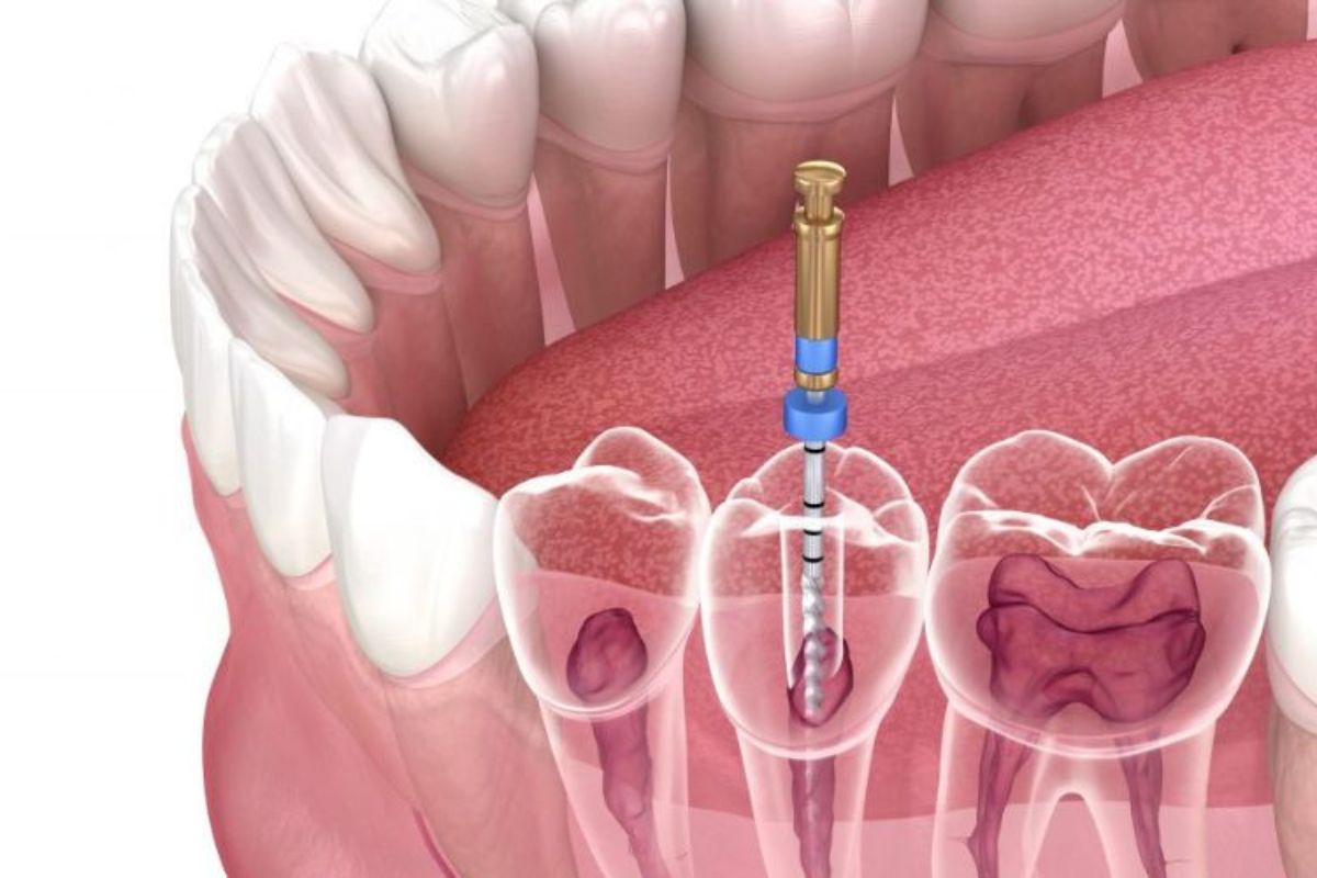 When is a Root Canal Necessary?