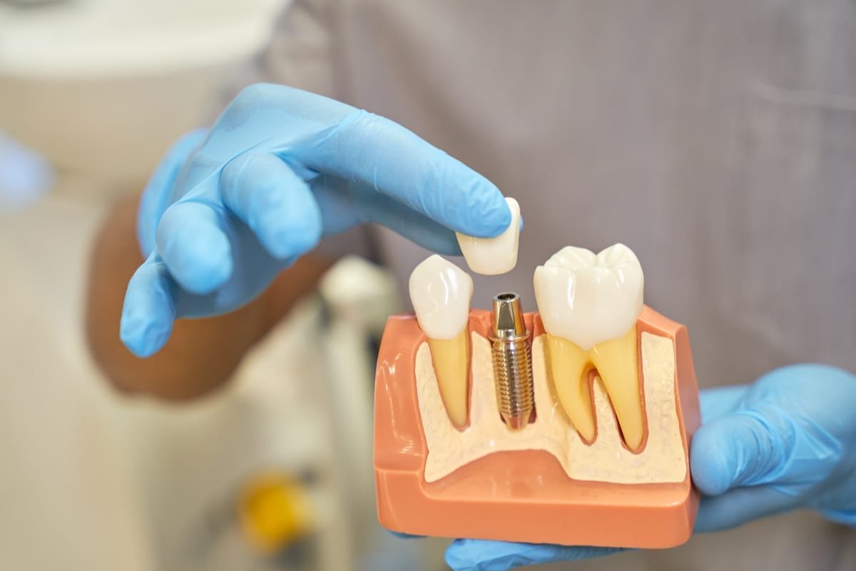 Dental Implants in Millbrae