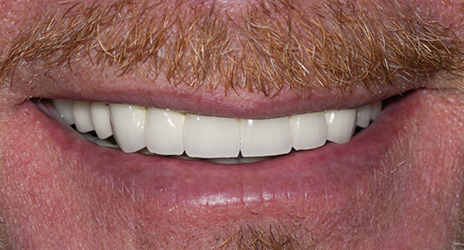 Close up of teeth after treatment at Broadway Dental of Millbrae