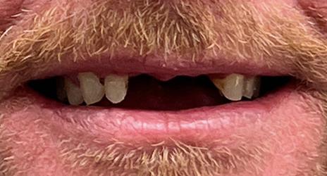 Close up of teeth before treatment at Broadway Dental of Millbrae