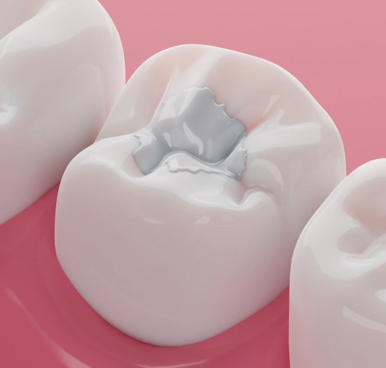 Tooth restored with a natural-looking composite filling