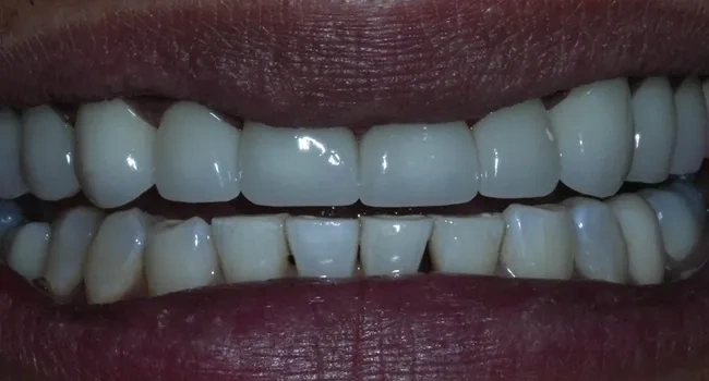 Cosmetic dentistry smile makeover after treatment
