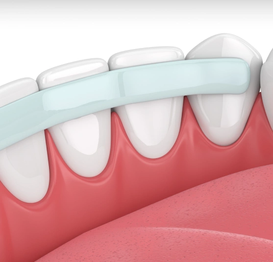 Illustration of cosmetic dental bonding procedure