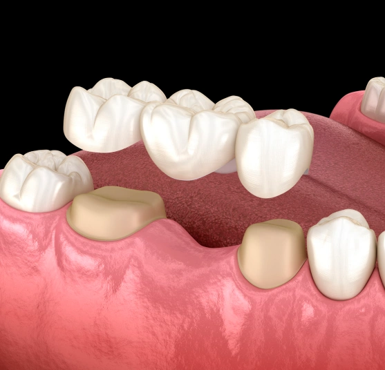 Illustration of a dental bridge replacing missing teeth
