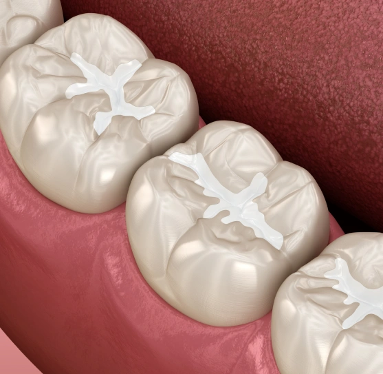 Dental sealants protecting teeth from cavities