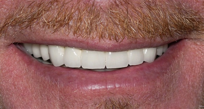 Full mouth reconstruction after treatment results