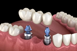 Model of implant bridges