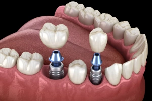Model of implant crowns