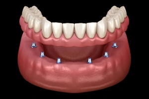 Model of implant supported dentures