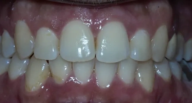 Invisalign treatment after results