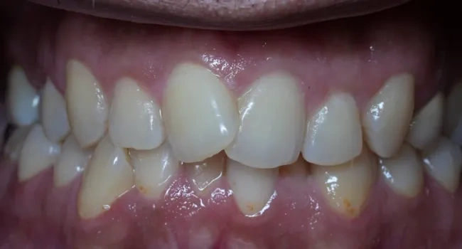 Teeth before Invisalign treatment