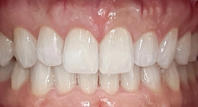 Orthodontic treatment after results