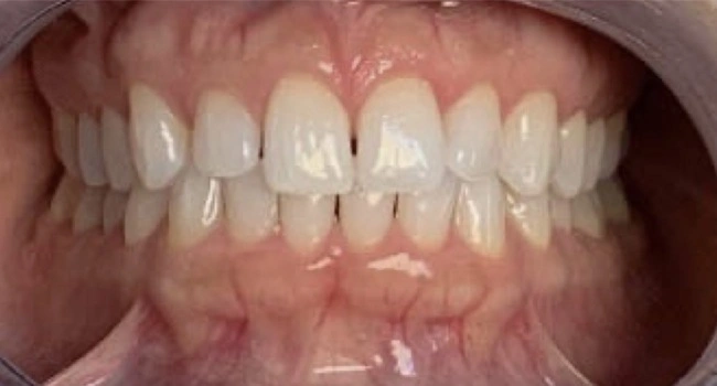 Teeth before Invisalign orthodontic treatment