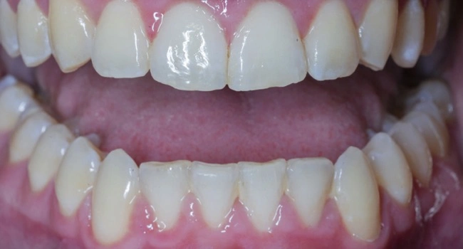 Teeth straightening with Invisalign after treatment