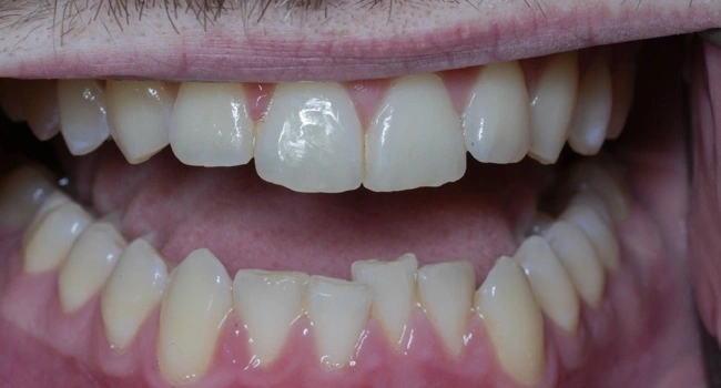 Teeth before Invisalign straightening treatment