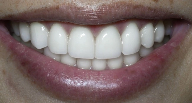 Invisalign and veneers smile makeover after treatment
