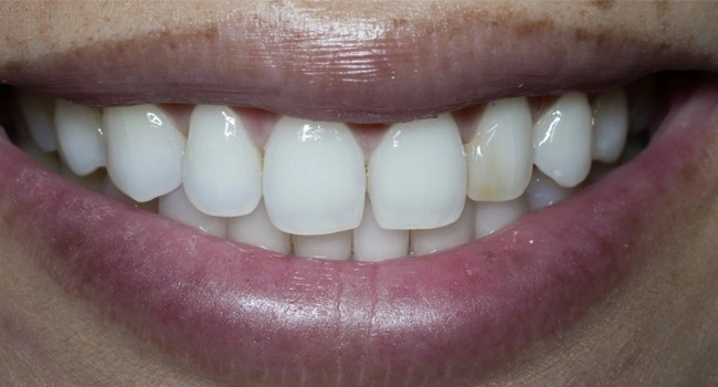 Invisalign and veneers before treatment