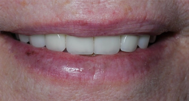 Porcelain veneers after smile transformation