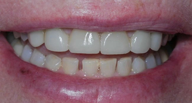 Smile before porcelain veneer treatment