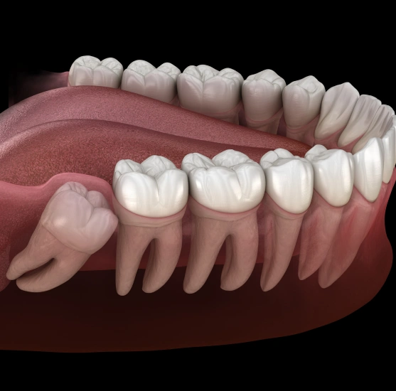 Illustration of wisdom tooth extraction