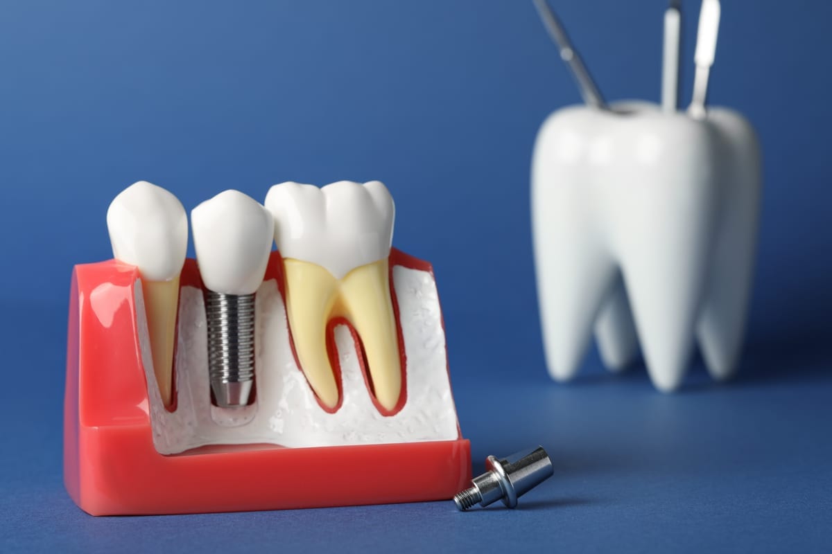Dental Implants in Millbrae